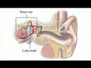 Meniere's disease